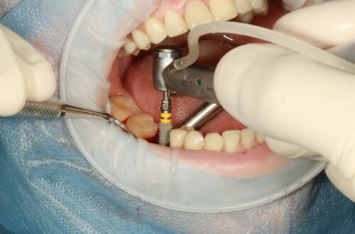 How to choose Teeth Implant